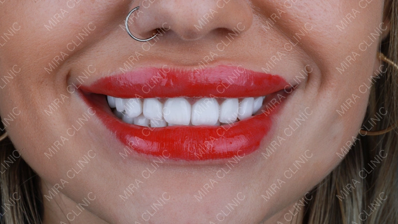 common risks of veneers